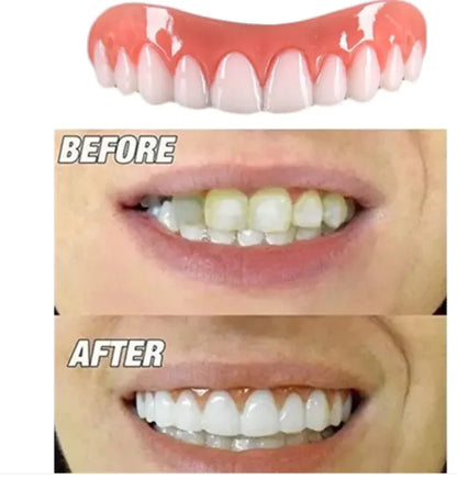 Flexi Smile Braces